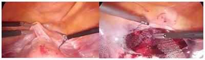 Postoperative results of laparoscopic lateral suspension operation: A clinical trials study